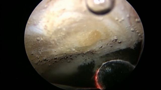 Vaporesection of the prostate using Plasma kinetic energy TURI استئصال البروستاتا بلازما смотреть онлайн