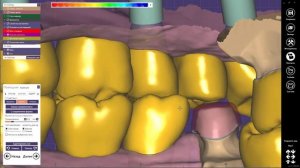 EXOCAD моделировка циркона, импланты и коронки