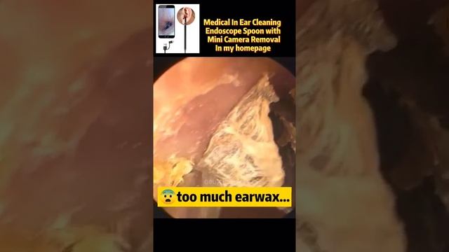 Best Ear Wax Removal & Extraction with Vacuum Remover 真空リムーバーによるにきびの除去と抽出 161 смотреть онлайн