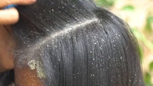 Dandruff Shampoo and Scratching, Itchy Dry Scalp, Huge Flake, Psoriasis Treatment #369