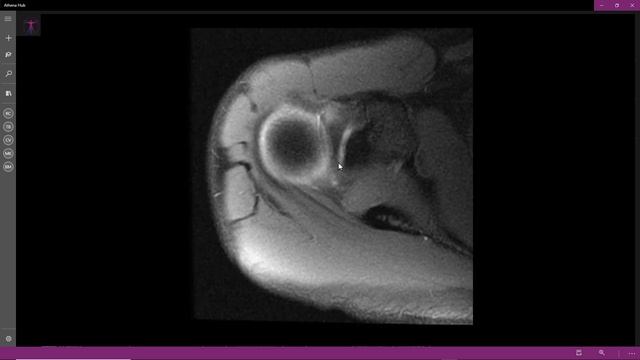 Lesão labral смотреть онлайн
