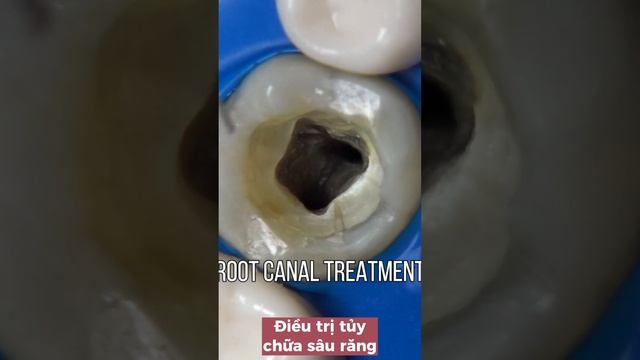 Điều trị tủy sâu răng. смотреть онлайн
