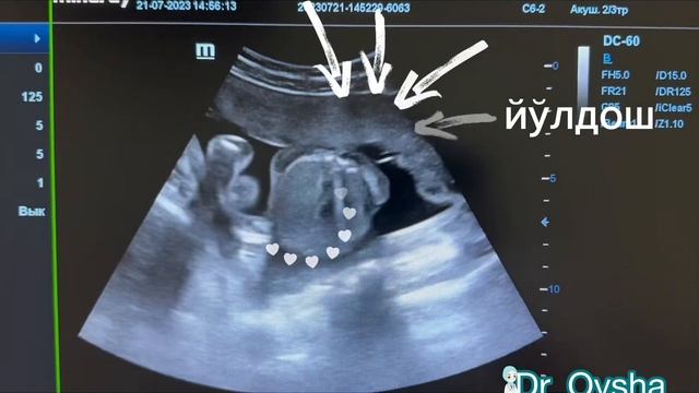 Homiladorlikda Skrining Tekshiruv Nechi Marta Qilinadi #homila #homiladorlik #chaqaloq #УЗИ #hamile
