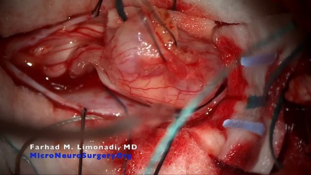 Spinal Schwannoma : Surgical Resection Of Spinal Tumor.  Technical Review With Case Presentation.
