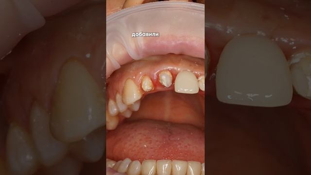Пациентка принесла коронку в руке! Штифты практически проломили корень и вышли наружу 😧 смотреть онлайн