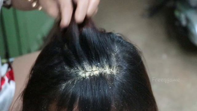 Removed Hundred of Lice From Head and Dry Scalp Huge Dandruff of Flakes Removal With Comb # 1765 смотреть онлайн