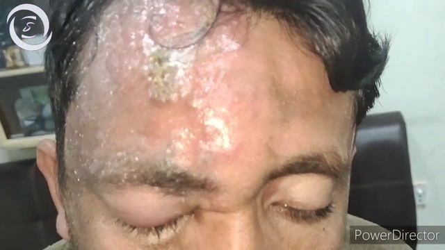 Herpes Zoster Ophthalmicus acute shingles смотреть онлайн