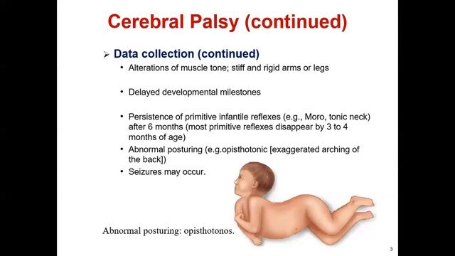 Pediatrics Neurology Cerebral Palsy