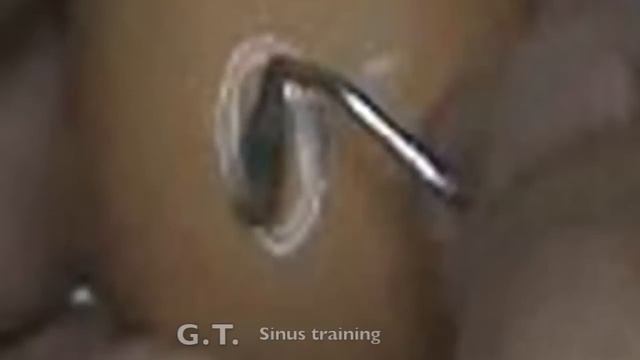 Training Sinus lift empty egg смотреть онлайн