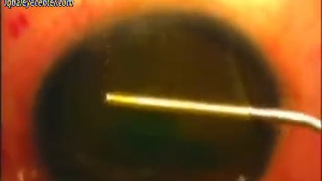 Femtosecond laser Myo Ring Implantation Combined with Cross-Linking смотреть онлайн