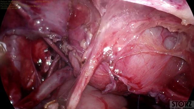 Pediatric Laparoscopic Bladder Neck Repair & B/l Extravesical Ureteric Reimplant