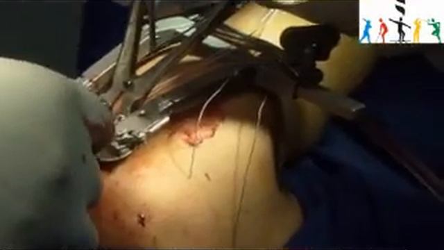 Mini open double row rotator cuff repair by Dr Raju Easwaran смотреть онлайн
