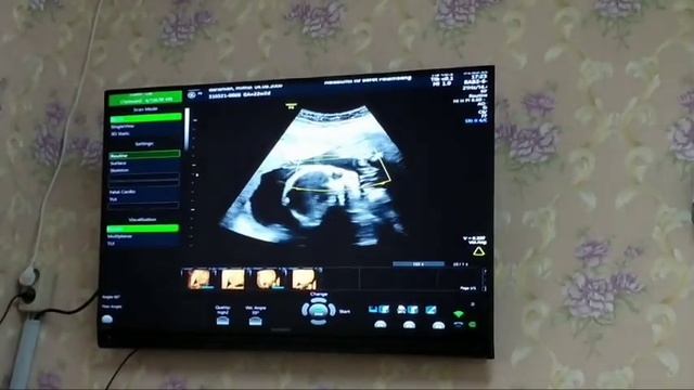 USG 4 DIMENSI KANDUNGAN , wajah dan kelamin terlihat jelas смотреть онлайн