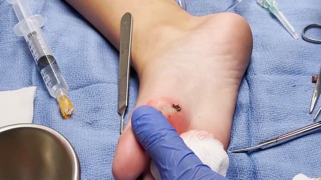 Huge Splinter Stuck in 7th Grader's Foot смотреть онлайн
