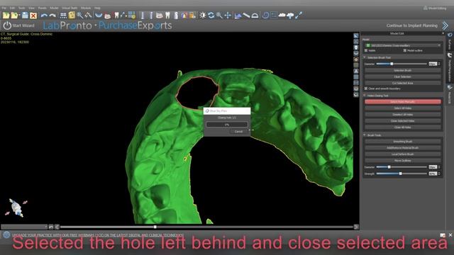 Blue Sky Plan digital extraction and surgical guide design смотреть онлайн
