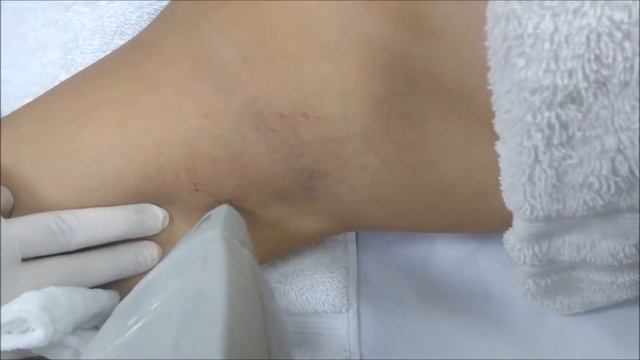 Depilação a Laser - Light Sheer смотреть онлайн