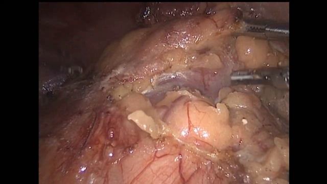 08 09 2022 Laparoscopic Left Partial Nephrectomy / Лапароскопическая Резекция левой почки смотреть онлайн