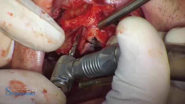 ALL ON 6 IMPLANTSWISS смотреть онлайн