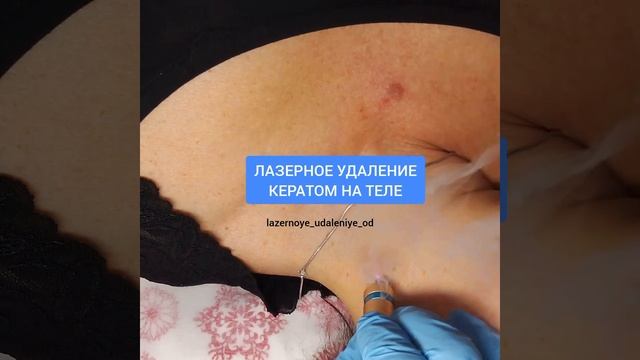 Лазерное удаление кератомы на теле смотреть онлайн