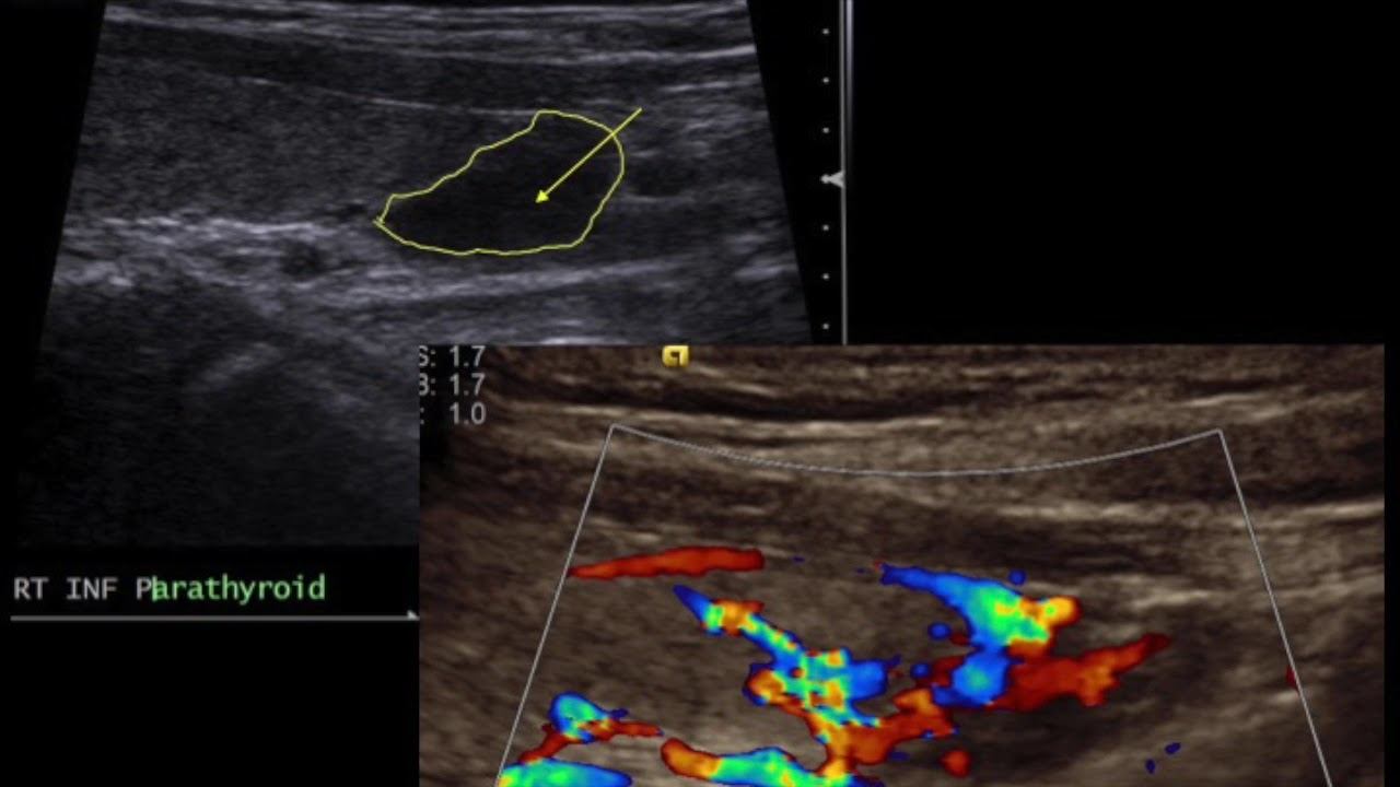 TMT: Neck Ultrasound: Parathyroid Nodule смотреть онлайн