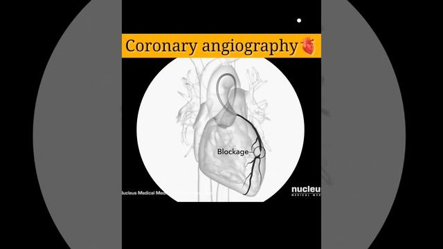 Coronary angiography and angioplasty 🤩❤️#short #science #funny смотреть онлайн