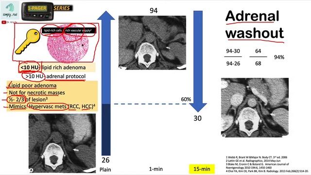 CT Adrenal Protocol (washout) 1/2 смотреть онлайн
