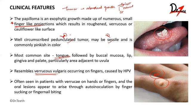 Squamous Papilloma | Oral Pathology Lectures смотреть онлайн