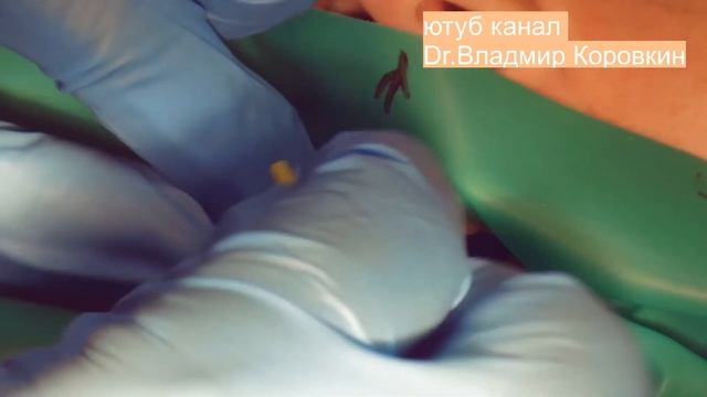 Кейс раббердам .Медента.Изоляция 6 зубов Корд+Бринкер В4.#rubberdam #rubberdamology смотреть онлайн