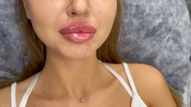 Увеличение губ видео процесса 18 смотреть онлайн