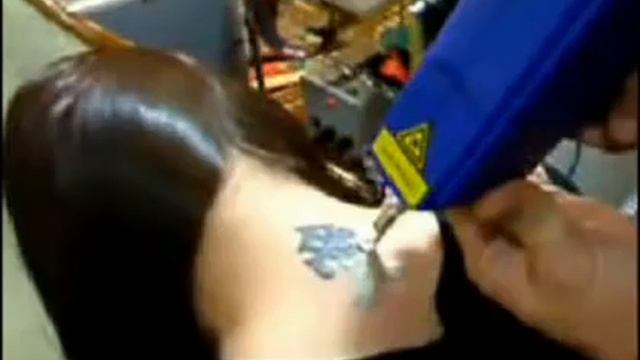Laser Q-Switched Nd:Yag Rimozione Tatuaggio смотреть онлайн
