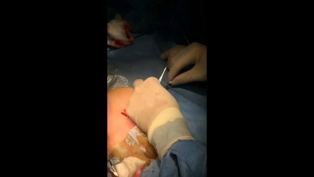 Celsite Epoxy port Implantation смотреть онлайн