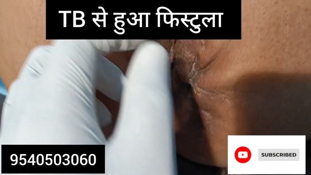TB के कारण हुआ फिस्टुला...... смотреть онлайн