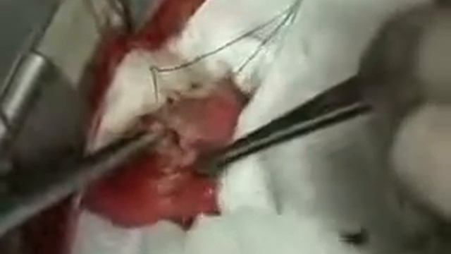 ПАРАЗИТЫ-ОПУХОЛЬ В СЕРДЦЕ ЧЕЛОВЕКА. ЛЕНТОЧНЫЕ ПАРАЗИТЫ. PARASITES. TUMOR смотреть онлайн