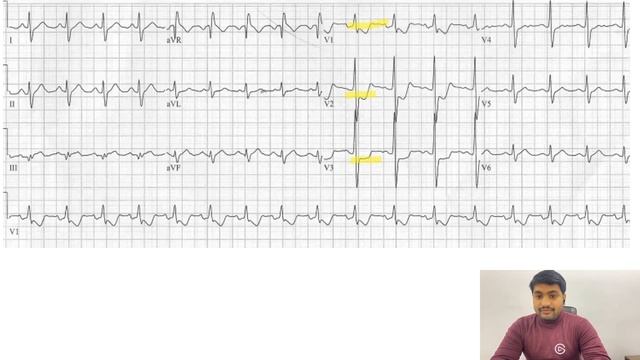 Mastering ECG:Lesson#8 Posterior wall MI; ECG discussion смотреть онлайн