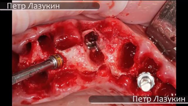 Установка Hi-Tec под углом смотреть онлайн