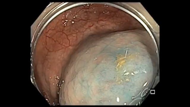 Sessile Serrated Adenoma in Crohn's disease EMR смотреть онлайн