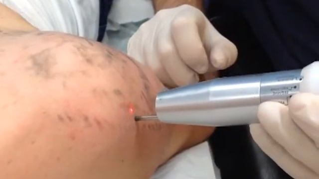 tattoo removal with a 1064 nm QS laser смотреть онлайн