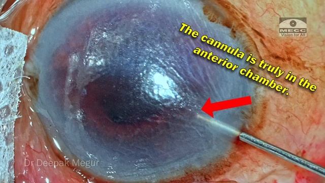 Inferior Descemet's Membrane Detachment (DMD) Management. Dr. Deepak Megur смотреть онлайн