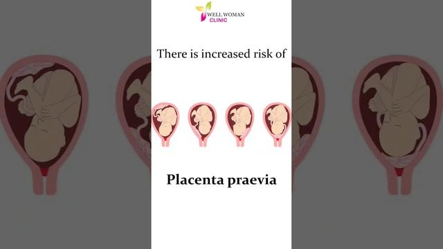𝐃𝐨 𝐅𝐢𝐛𝐫𝐨𝐢𝐝𝐬 𝐢𝐧𝐜𝐫𝐞𝐚𝐬𝐞 𝐩𝐫𝐞𝐠𝐧𝐚𝐧𝐜𝐲 𝐫𝐢𝐬𝐤? | 𝐃𝐫 𝐍𝐮𝐩𝐮𝐫 𝐆𝐮𝐩𝐭𝐚 | 𝐖𝐞𝐥𝐥 𝐖𝐨𝐦𝐚𝐧 𝐂𝐥𝐢𝐧𝐢𝐜 смотреть онлайн