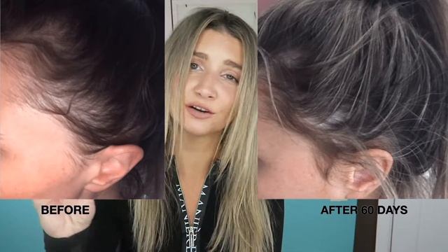 HAIR REGROWTH MIRACLE?! JS HEALTH смотреть онлайн