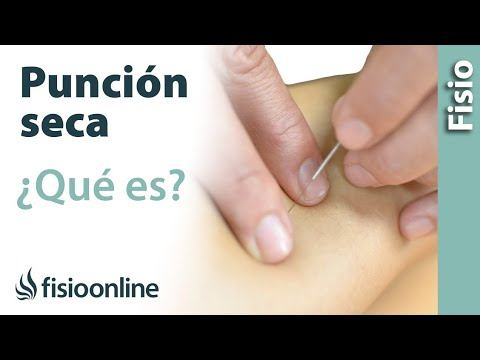 Qué es la punción seca y para qué se utiliza en fisioterapia. смотреть онлайн