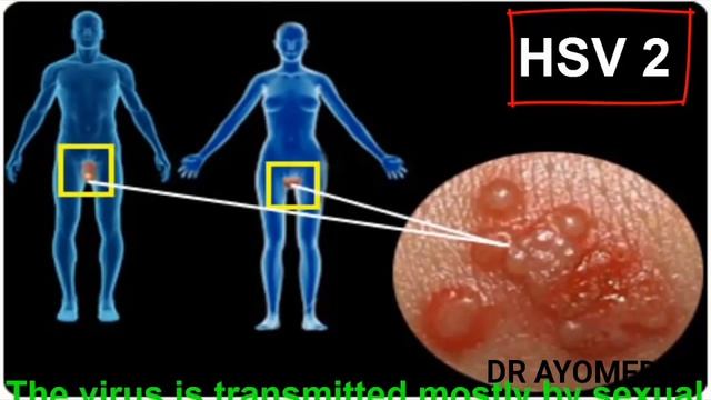 Get rid of Herpes Simplex Virus 1&2 Dr AYOMEDE.. смотреть онлайн