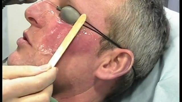 Pulsar IPL Treatment Video 2 смотреть онлайн