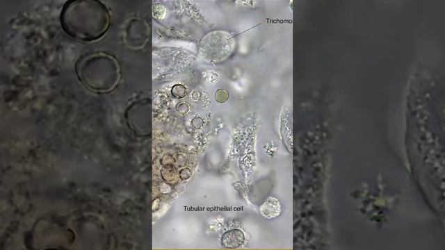 #Trichomonas digging around #rbc cast and some glitter cells - brightfield, unstained. #parasite смотреть онлайн