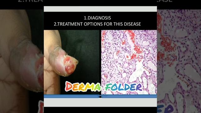 PYOGENIC GRANULOMA (SHORT CASE ) смотреть онлайн