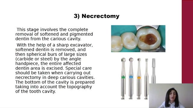 Lecture 3. Principles of preparation of carious cavities Class 1 by Black смотреть онлайн