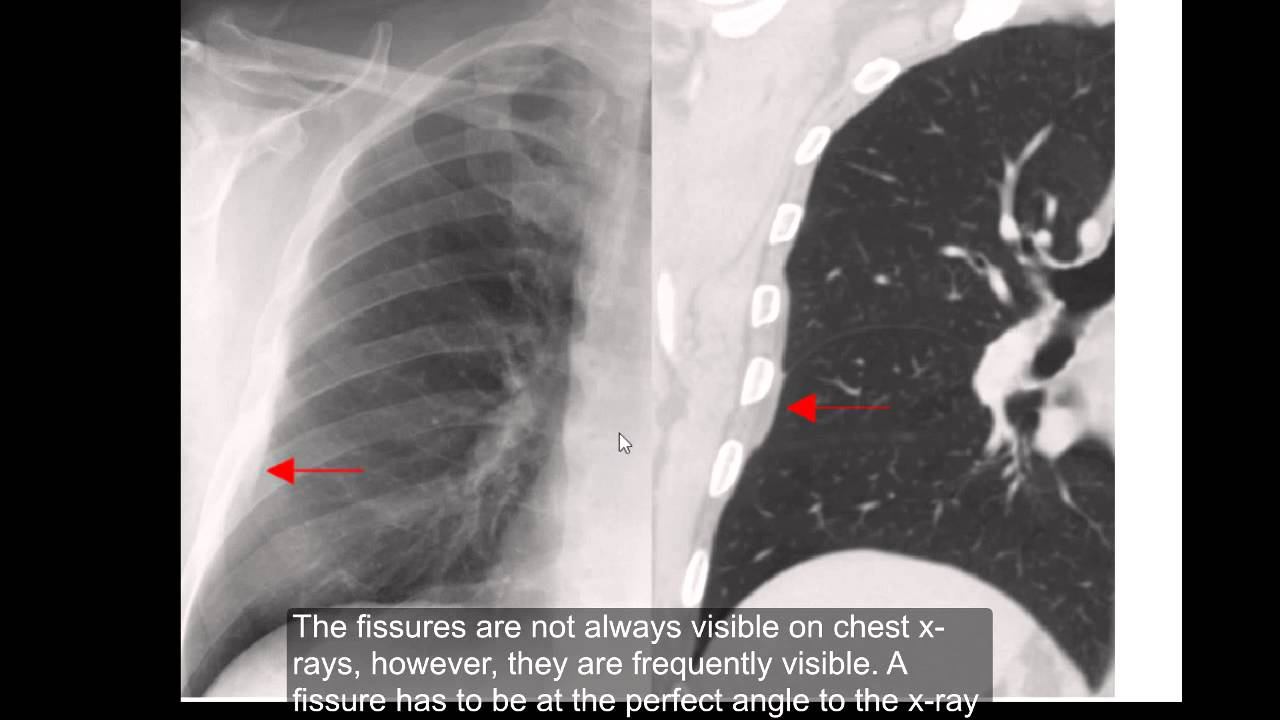 Pleura and pleural cavity- and associated conditions смотреть онлайн