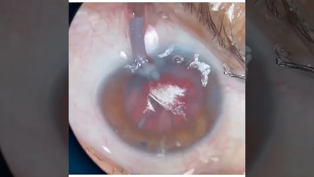 Phacoemulsification with intraocular lens (IOL) implantation. ФЭК + ИОЛ смотреть онлайн