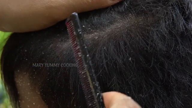 Dandruff Scratching Big Flakes Left Side!! Dandruff Removal #240 смотреть онлайн