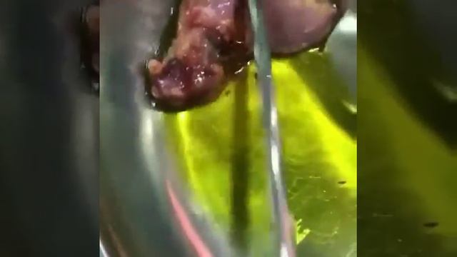 Cholesterol gallstones being extracted-Colesterol cálculos biliares que se extraen смотреть онлайн